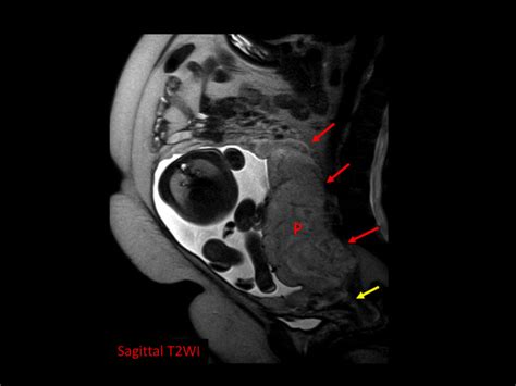 Placenta Percreta In A 30 Year Old Woman With A 3rd Trimester Download Scientific Diagram