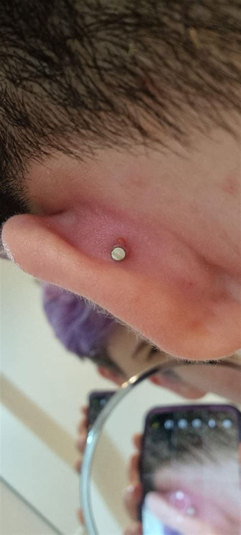 Irritation Bump On Conch Piercing R Piercingadvice