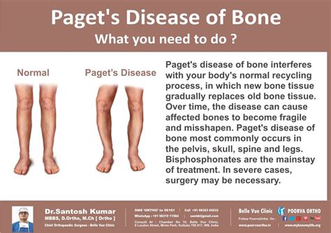 Stages Of Paget's Disease Skin