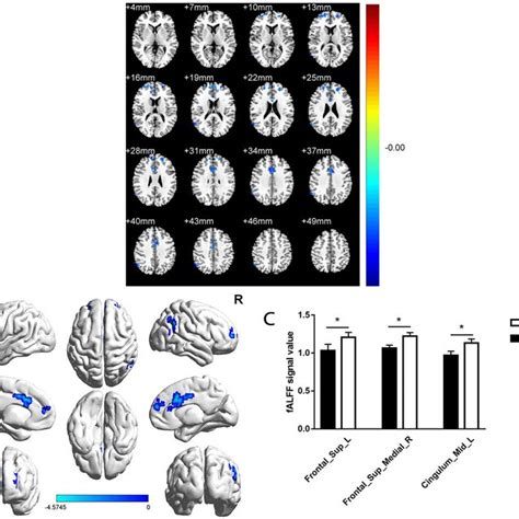 Spontaneous Brain Activity In Ta Patients And Hcs A B Regions With