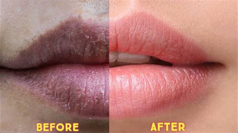 How To Get Plump Soft Pink Lips Lip Care Routine Get Healthy Lips At Home Ll Grow Mystery