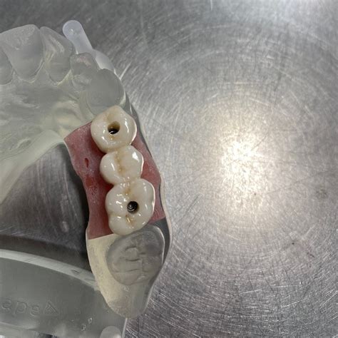 Multiunit Abutment Bridge — Hub City Dental Lab