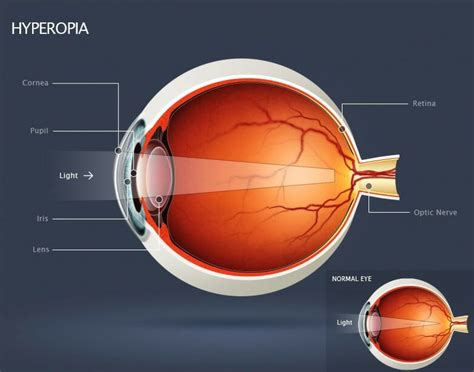 Hyperopia Hypermetropia Farsightedness