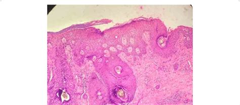 Histopathological Examination Revealing Acanthotic Epidermis With Large