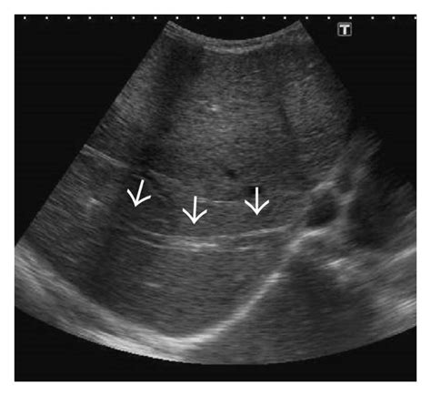 Gray Scale Us Images From Two Different Patients Demonstrating