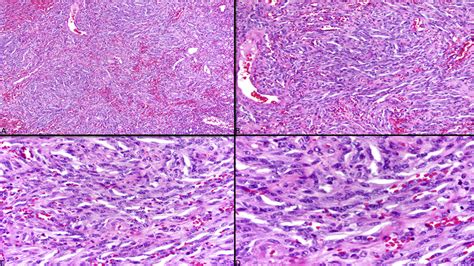 Kaposi Sarcoma A Low Power View Showing A Lesion Composed Of