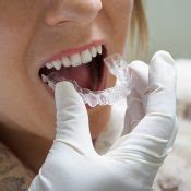 How To Straighten Your Teeth Without Braces Ifpafederation