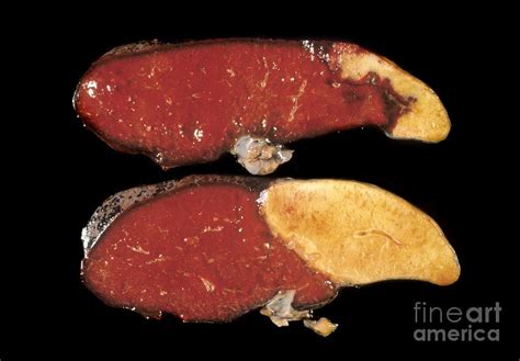 Splenic Infarct Photograph By Cnri Fine Art America