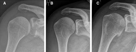 Arthroscopic Reduction And Fixation Of Large Solitary And