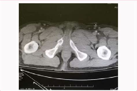 Right Superior And Inferior Pubic Rami Fractures Download Scientific Diagram