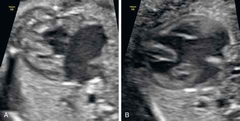 Atrioventricular Septal Defect Radiology Key