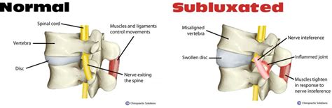 What is a Subluxation? – Discover Chiropractic