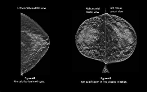 Benign Breast Calcifications Article