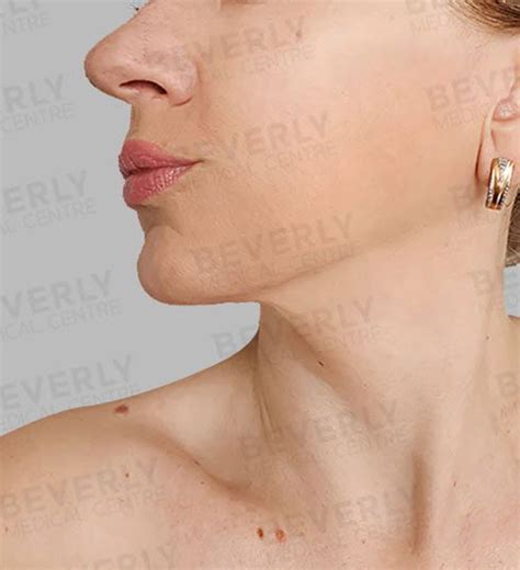 Rediscover Your Youth With Facelift Surgery At Beverly Wilshire