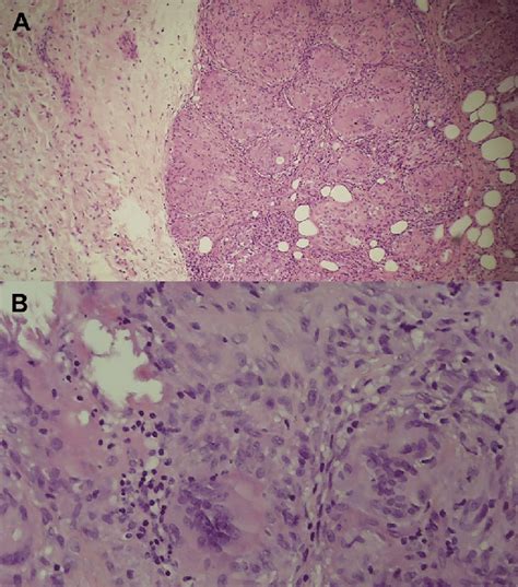 A Multiple Noncaseating Granulomas Associated With Fibrosis And Mild