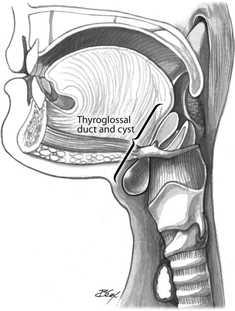 Thyroglossal Duct Cyst Excisionthe Sistrunk Procedure Operative