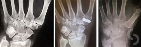 Thumb Basal Joint Arthritis Dr Sonja Cerovac