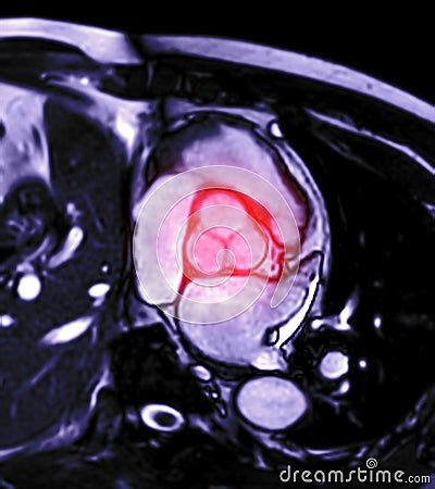 MRI Heart Or Cardiac MRI Magnetic Resonance Imaging Of Heart Showing ...