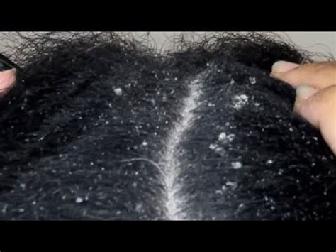 ASMR Dandruff Scratching Satisfying Itch Scalp Check Itching