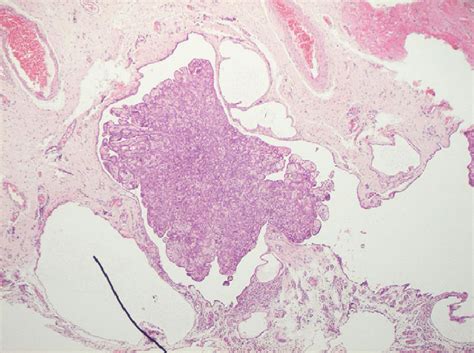 H E Staining Of The Specimen Demonstrating A Fibrous Cyst Wall Covered