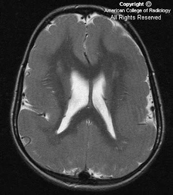 Neuroradiology On the Net: Pachygyria