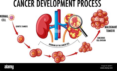 Diagram Showing Cancer Development Process Illustration Stock Vector