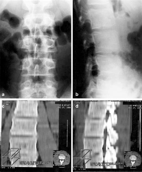 A D Case 2 A Ap And B Lateral Radiographs Of The Lumbar Spine Reveal