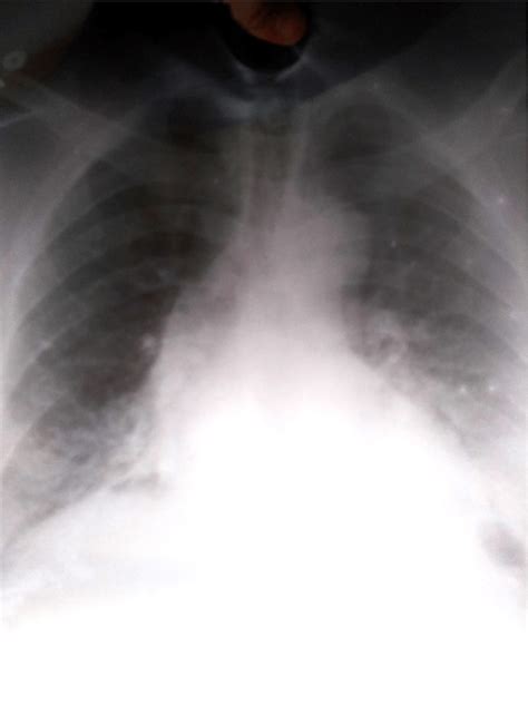 Patients Chest X Ray Showing A Widened Mediastinum Download