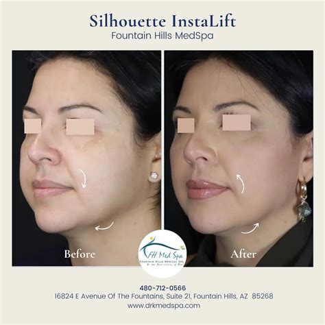 Silhouette Instalift Non Surgical Skin Lift Fountain Hills Med Spa