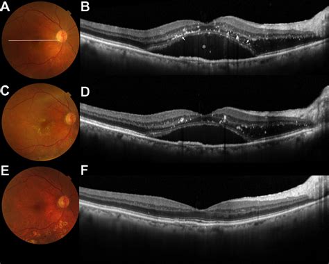 Serous Retinal Detachment Oct