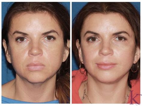 Mini Facelift Before And After Photo Gallery NYC New York NY