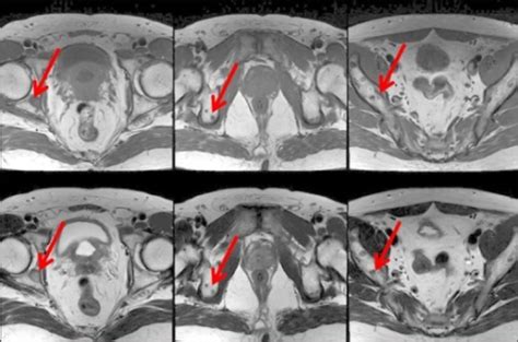 Axial T1 And T2 Weighted Mri Of The Pelvis Reveals Mul Open I