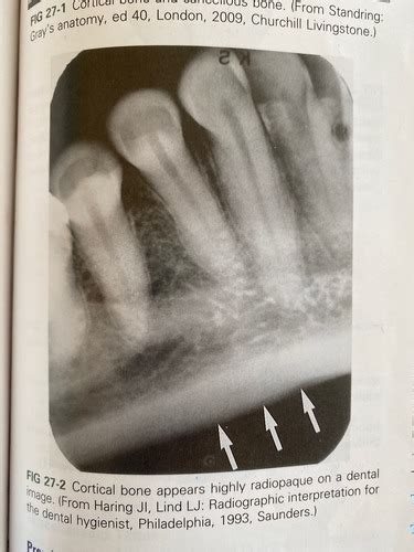 Normal Anatomy Intraoral Images Flashcards Quizlet