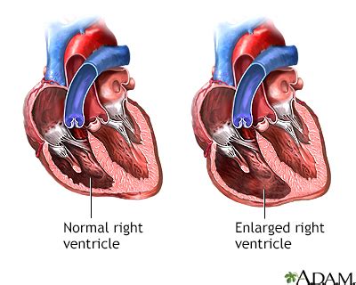 Tricuspid regurgitation Information | Mount Sinai - New York