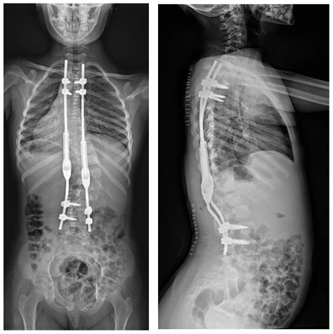 Growing Rods Scoliosis Procedure at Victor Fox blog