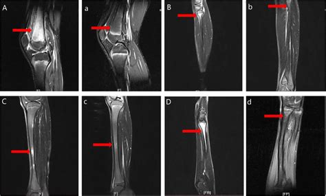 MRI findings in case 13 with chronic nonbacterial osteomyelitis. MRI... | Download Scientific ...