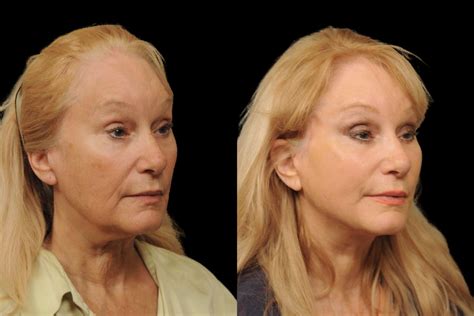 Patient 246949 Changes Rapid Lift Before And After Photos Changes