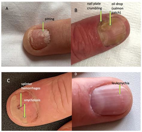 Ijerph Free Full Text Usefulness Of Ultrasound Examination In The Assessment Of The Nail