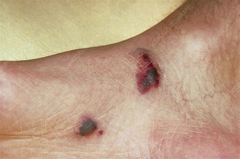 Hiv Rash On Feet