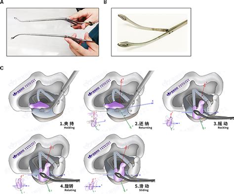 A Novel Five‐step Reduction Technique Of Arytenoid Dislocation Liu The Laryngoscope Wiley