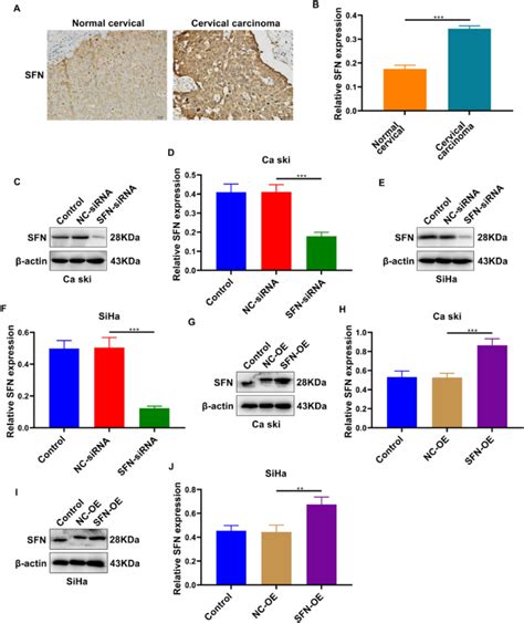 Stratifin SFN Regulates Cervical Cancer Cell Proliferation Apoptosis