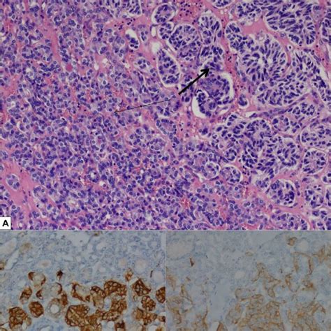 A Neuroendocrine Tumor Metastasis Bold Arrow Inside Papillary Thyroid