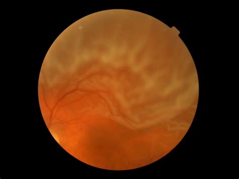 Retinal tear and detachment - The Retina Centers of Washington