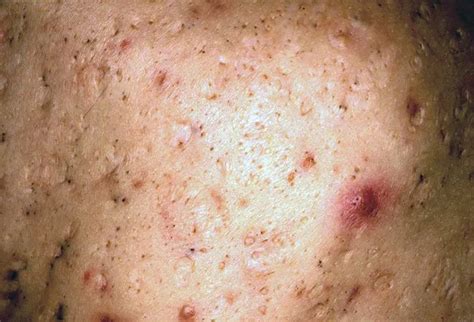 Acne Craters Mild To Moderate Craters Can Be Treated With Chemicals