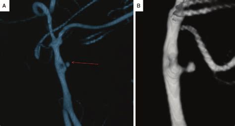 A And B Fenestration Deformity Of The Basilar Artery Trunk With An