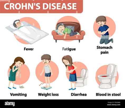 Medizinische Infografik Der Morbus Crohn Stock Vektorgrafik Alamy