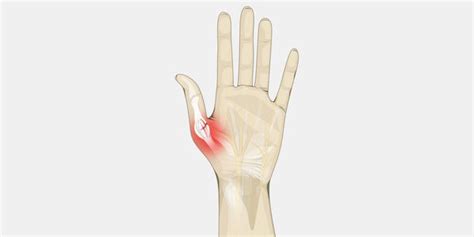 Sprained Thumb The Complete Injury Guide Vive Health