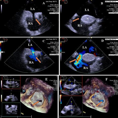 2d Tee And 4d Tee Images Revealed Lipomatous Hypertrophy Of The Atrial