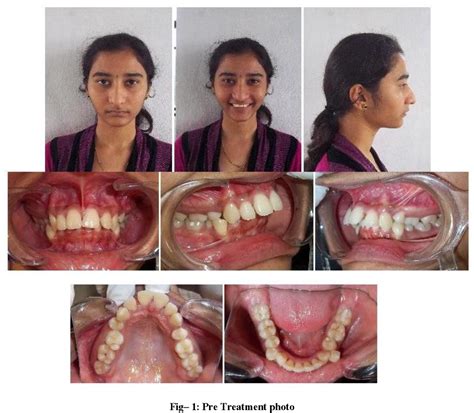 Surgical Orthodontic Treatment Of Skeletal Class II Malocclusion