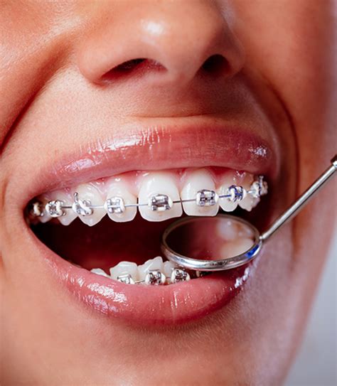 Traitement Orthodontique Appareils Dentaires Traitements Multi Bagues